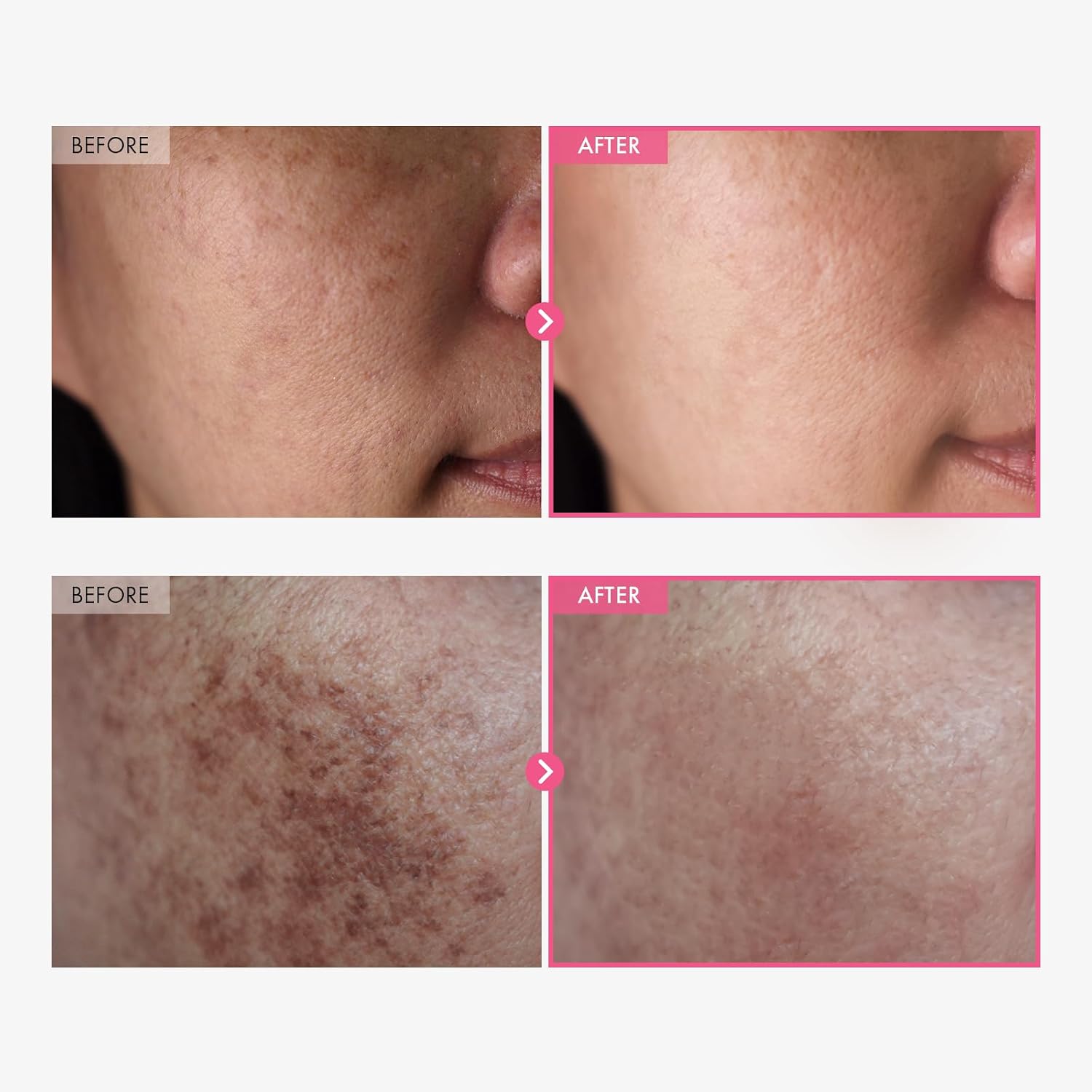 TOSOWOONG Arbutin 7% + Tranexamic Acid 4... 2 TOSOWOONG Arbutin 7% + Tranexamic Acid 4... - Image 2