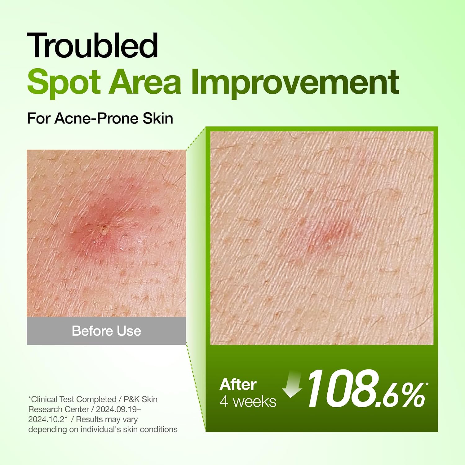 Anua Azelaic Acid 10 Hyaluron Redness So... 5 Anua Azelaic Acid 10 Hyaluron Redness So... - Image 5